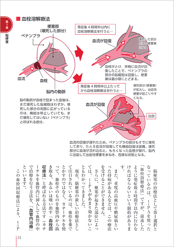 患者のための最新医学 脳梗塞 脳出血 くも膜下出血 高橋書店